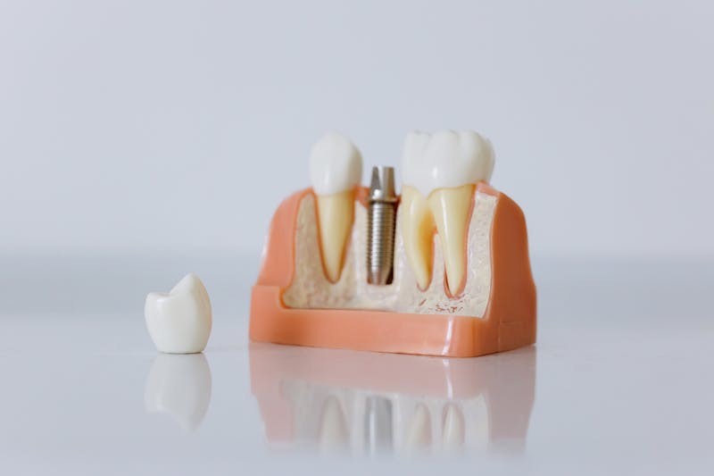 Single tooth implant