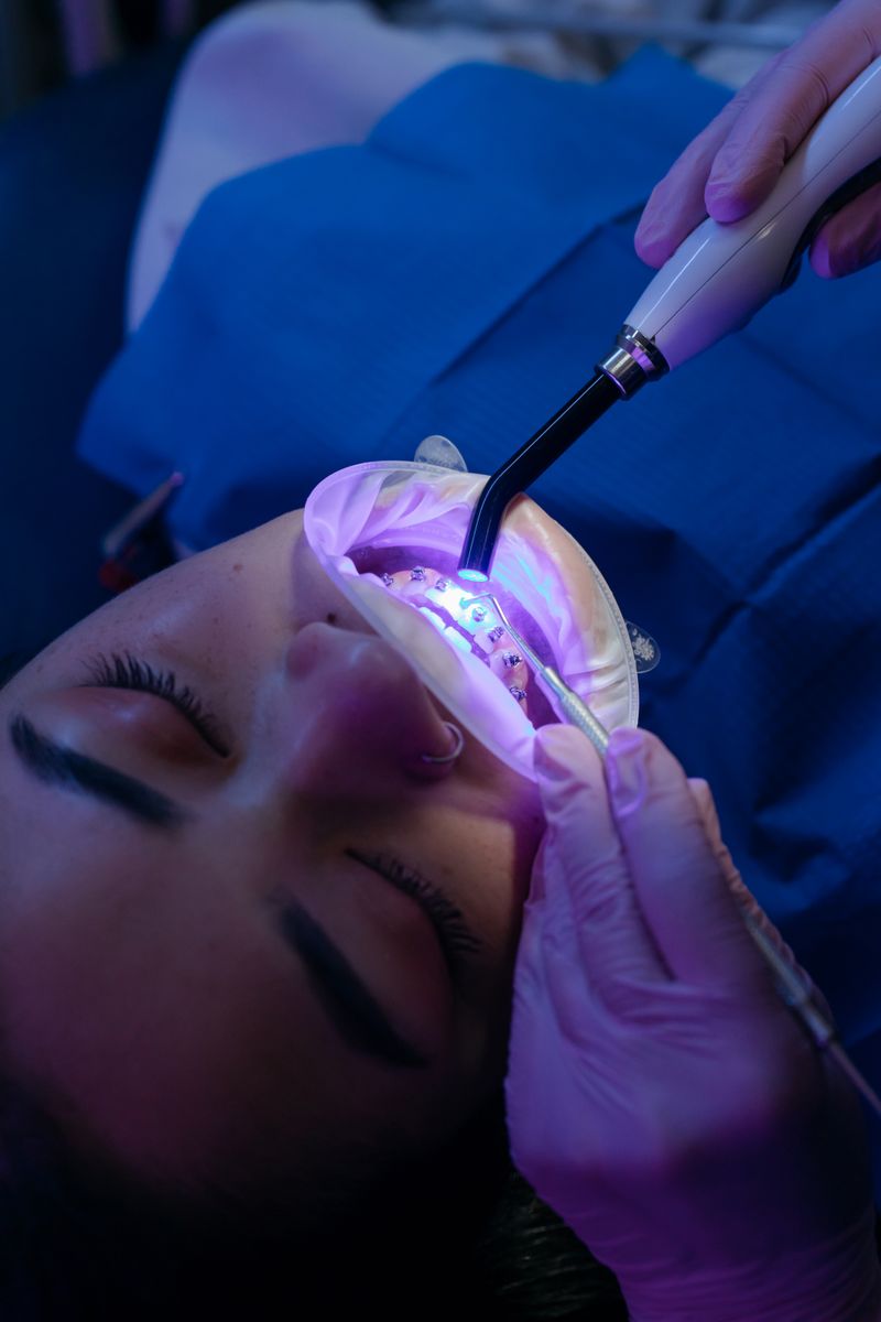 In-office whitening